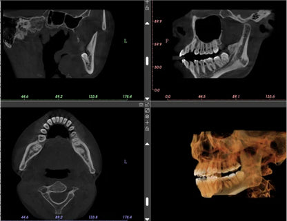 Ginee Medical Panoramic Dental X-ray Cbct 3d Panoramic Dental Machine Oral Scanner Dental cavity instruments digital unit CBCT