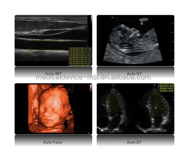 Sonoscape P50 ultrasound machine with color doppler echo detection