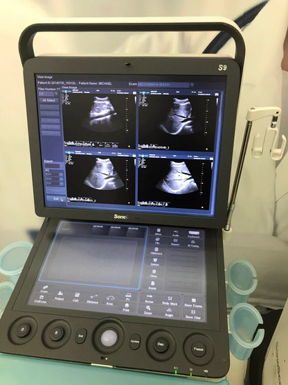 Sonoscape S9 Ultrasound Scanner Price Medical Ultrasound Instruments Portable 3D 4D Color Doppler Ultrasound Machine